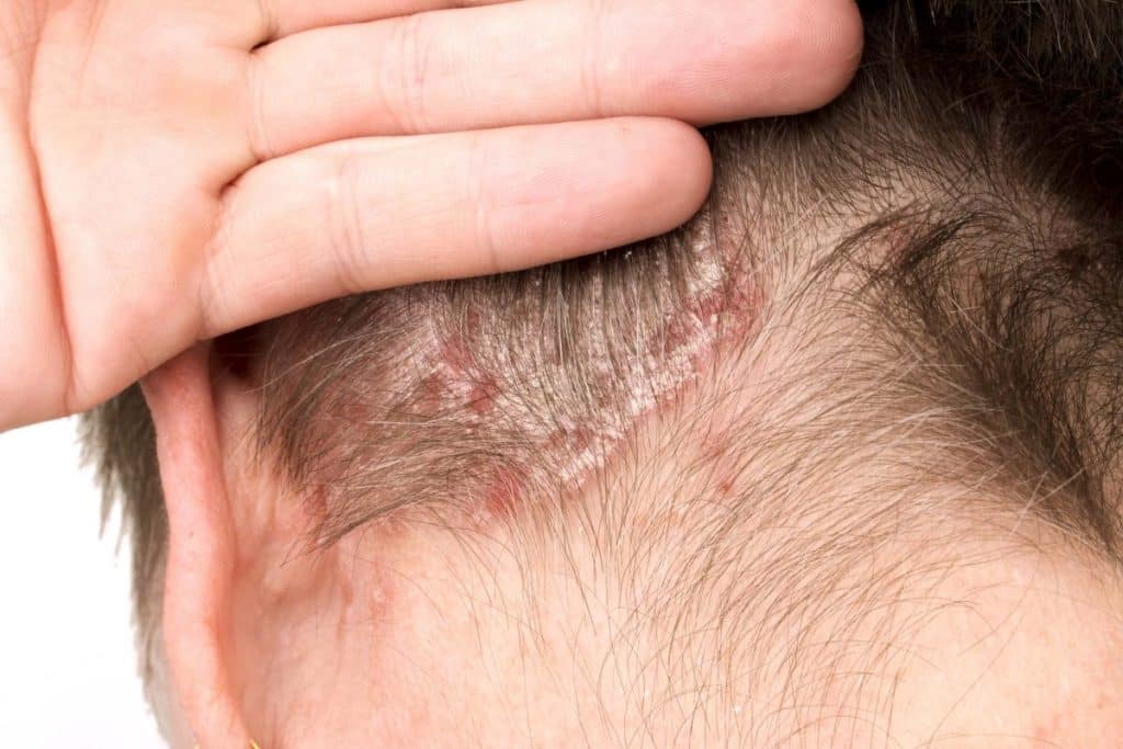 quel genre de traitements peut aggraver le psoriasis