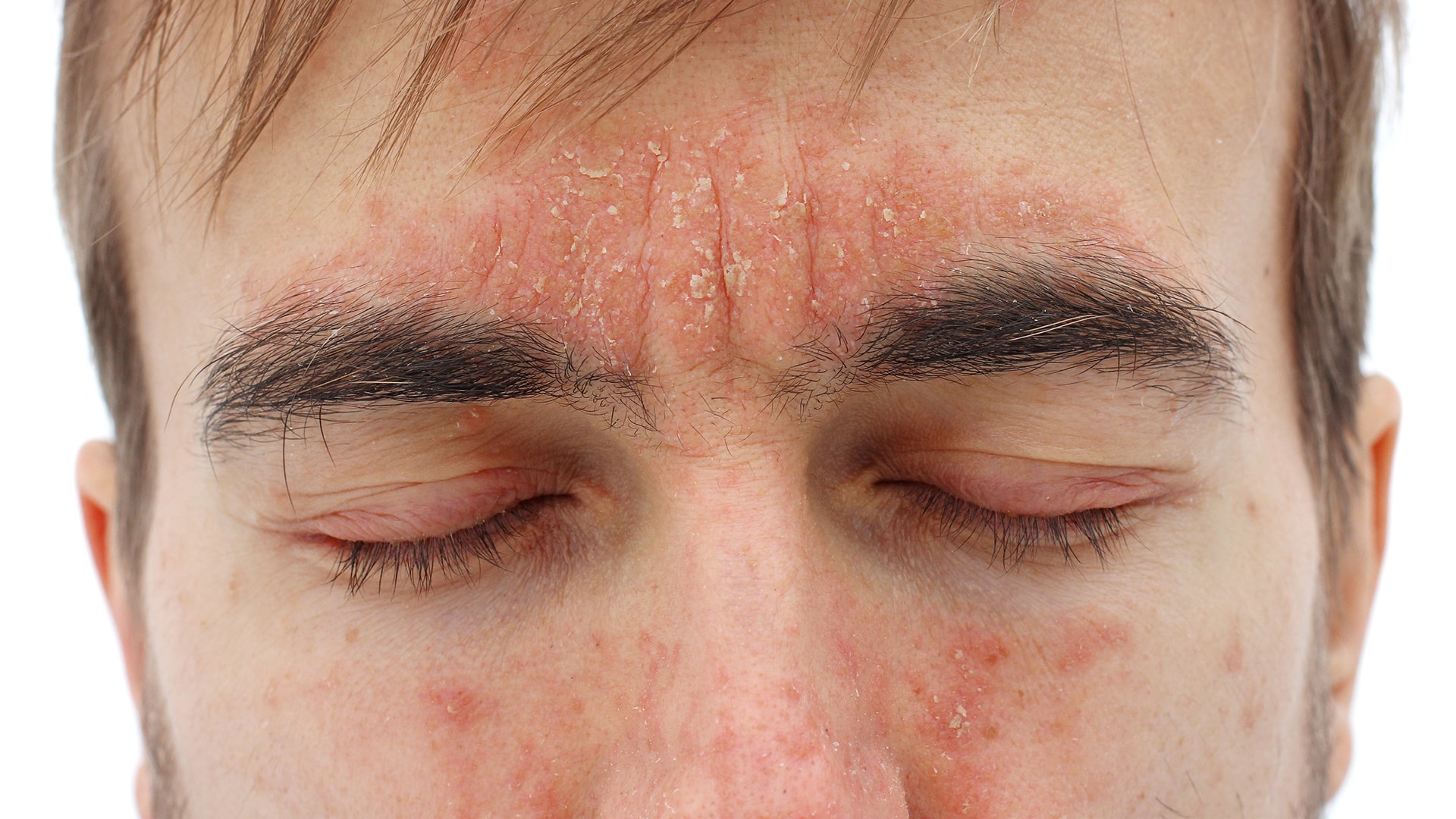 qu’est ce qui aggrave le psoriasis infos et astuces qu'est ce qui aggrave le psoriasis infos et astuces