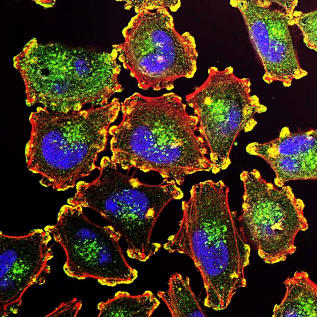 Quels facteurs peuvent aggraver le psoriasis ?